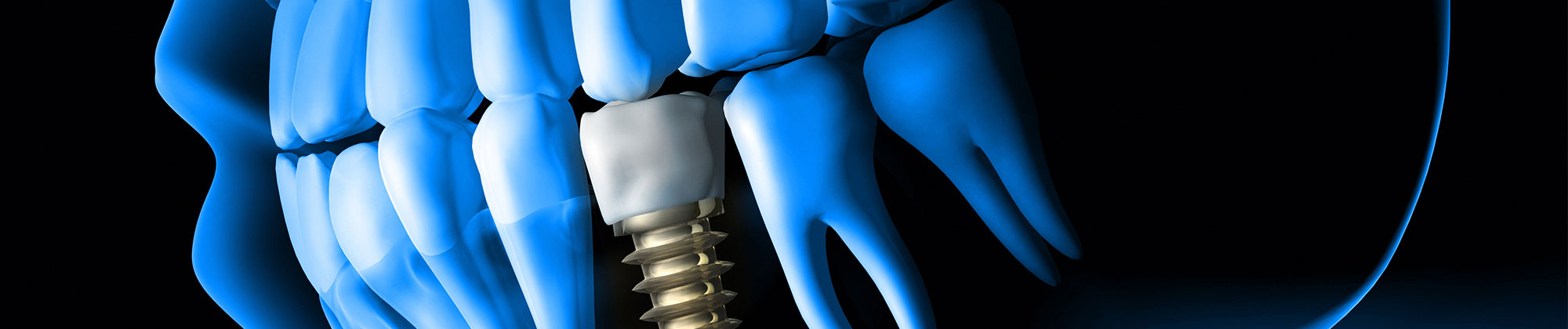 3D scan of dental implant